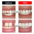 New Temporary Tooth Repair Kit Teeth And Gaps False Teeth Solid Glue Denture Adhesive Teeth Whitening Resin Tooth Beauty Tool